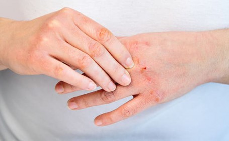 乳膠手套能否有效防止長水泡？
